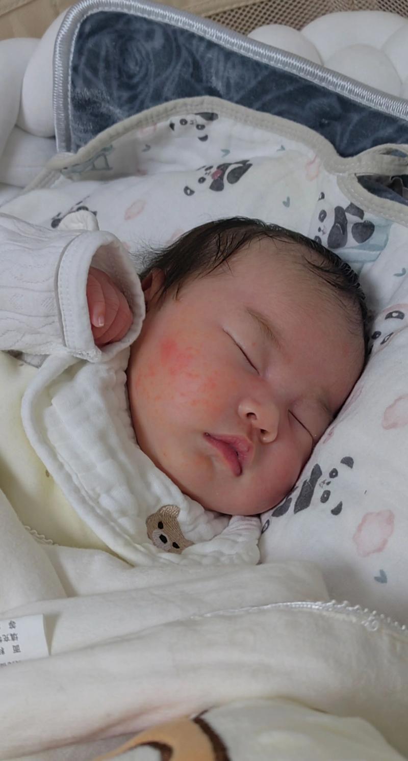 新生儿满脸红疙瘩是湿疹还是过敏？新手爸妈该如何正确护理？-第2张图片-郑州医学网