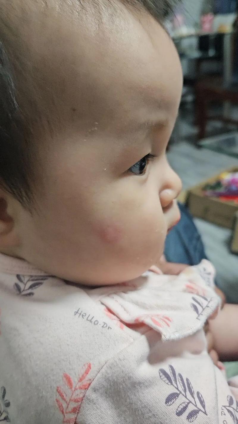 新生儿满脸红疙瘩是湿疹还是过敏？新手爸妈该如何正确护理？-第3张图片-郑州医学网