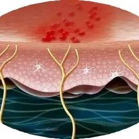 孕期复发性生殖器疱疹会对胎儿造成哪些影响？该如何科学应对？-第1张图片-郑州医学网