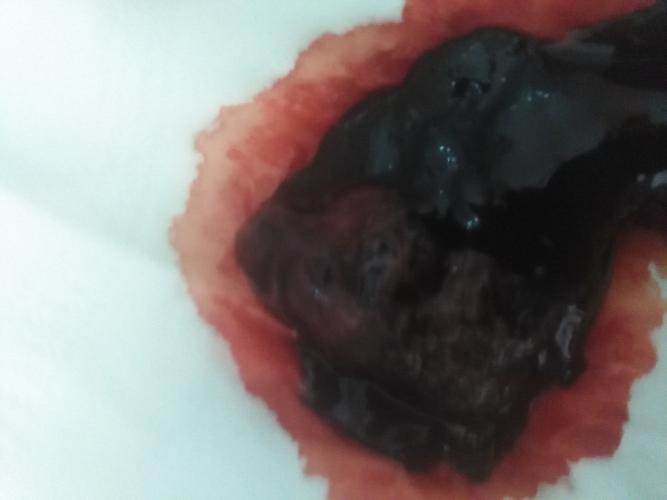 怀孕期间拉屎是黑色，是正常现象还是身体在报警？-第3张图片-郑州医学网