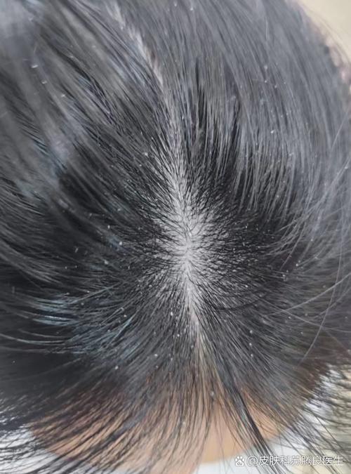 孕期头皮屑突然增多，是激素变化还是营养缺乏在作祟？-第1张图片-郑州医学网