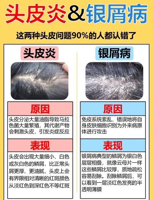 孕期头皮屑突然增多，是激素变化还是营养缺乏在作祟？-第2张图片-郑州医学网