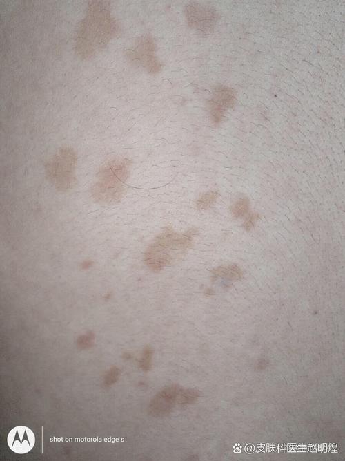 怀孕期间长汗斑是正常的生理现象还是健康预警？-第1张图片-郑州医学网