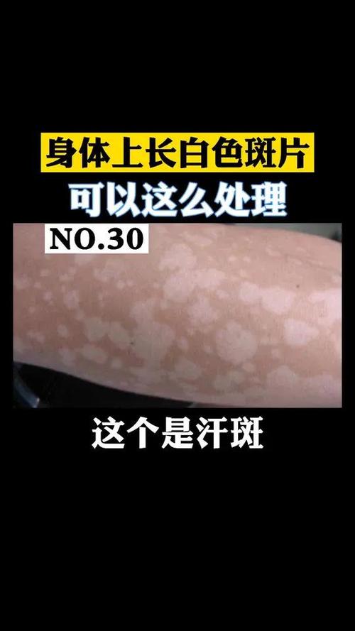 怀孕期间长汗斑是正常的生理现象还是健康预警？-第3张图片-郑州医学网