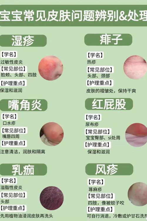 新生儿红屁股是正常现象还是护理不当？如何有效预防与护理？-第1张图片-郑州医学网