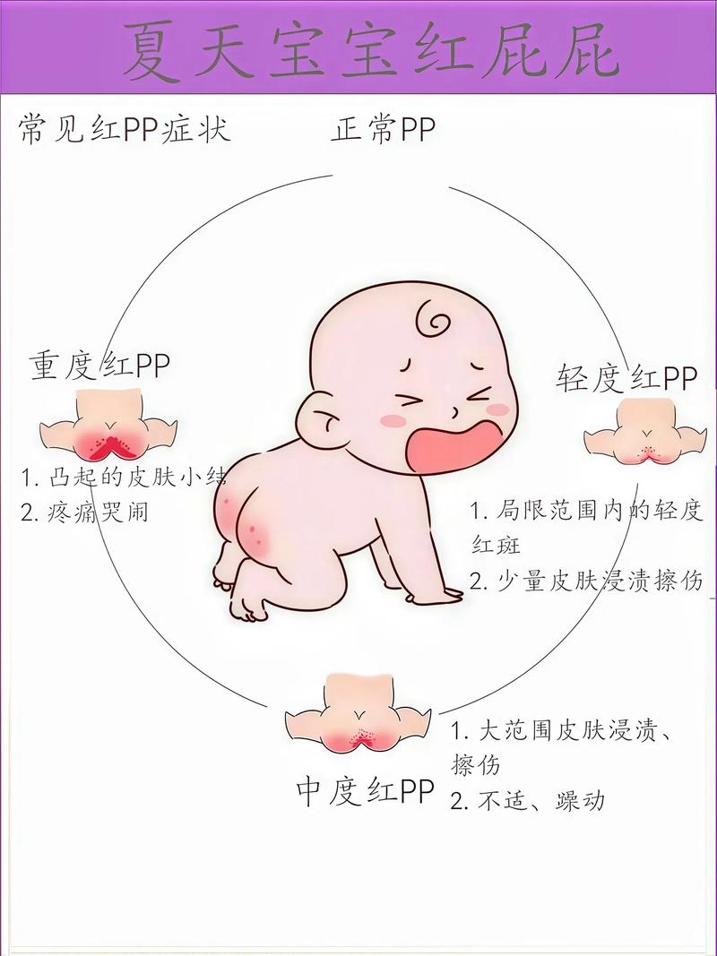 新生儿红屁股是正常现象还是护理不当？如何有效预防与护理？-第2张图片-郑州医学网