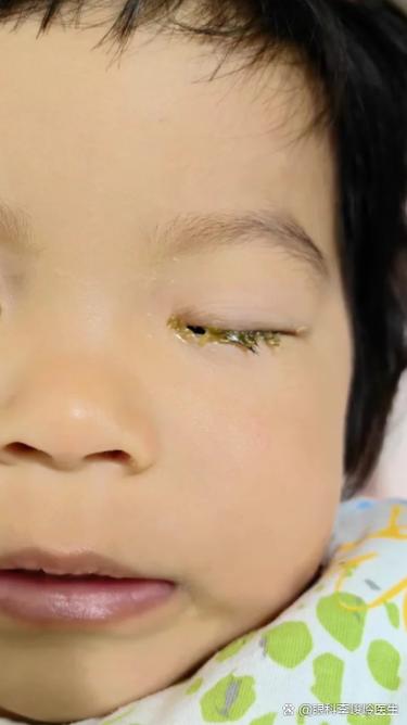 新生儿为什么总爱长眼屎？是上火还是生病了？新手爸妈别慌！-第2张图片-郑州医学网