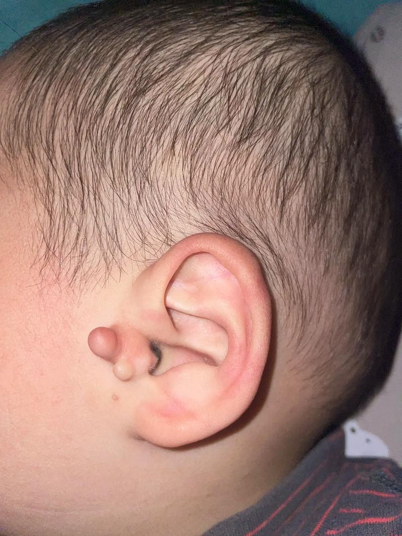 新生儿耳朵旁长出小附耳，是先天异常吗？需要手术切除吗？-第1张图片-郑州医学网