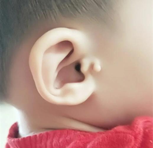 新生儿耳朵旁长出小附耳，是先天异常吗？需要手术切除吗？-第3张图片-郑州医学网