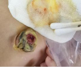 新生儿肚脐渗液图片正常吗？需要警惕哪些感染信号？-第2张图片-郑州医学网