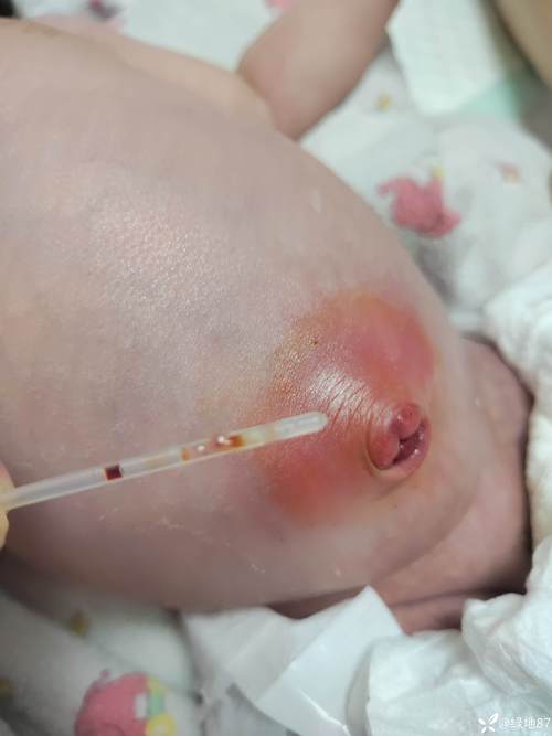 新生儿肚脐渗液图片正常吗？需要警惕哪些感染信号？-第1张图片-郑州医学网