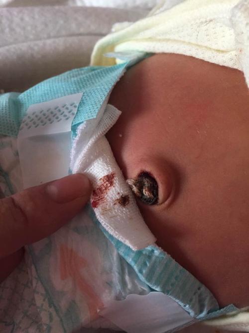 新生儿肚脐渗液图片正常吗？需要警惕哪些感染信号？-第3张图片-郑州医学网