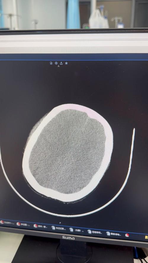 顺产新生儿蛛网膜出血是分娩意外还是可预防风险？-第1张图片-郑州医学网