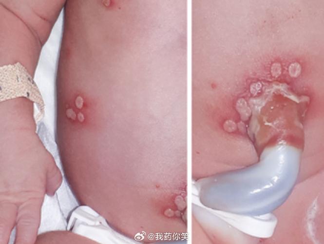 顺产新生儿蛛网膜出血是分娩意外还是可预防风险？-第2张图片-郑州医学网