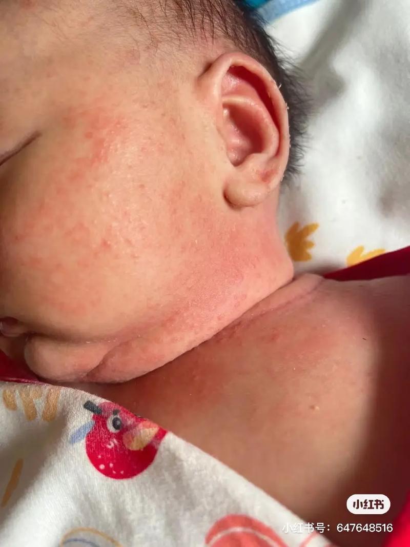 新生儿出现上热症状具体有哪些表现？家长该如何初步判断与应对？-第2张图片-郑州医学网