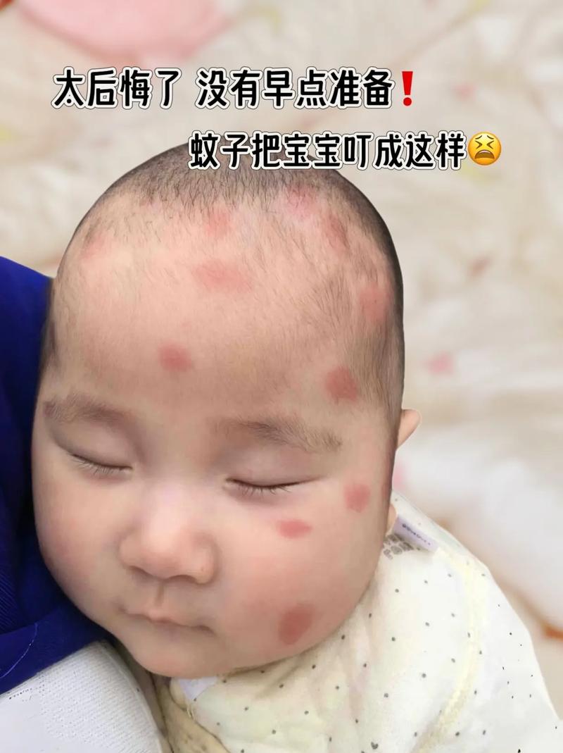 未满月新生儿被蚊子咬了怎么办？能用药吗？如何正确处理？-第2张图片-郑州医学网