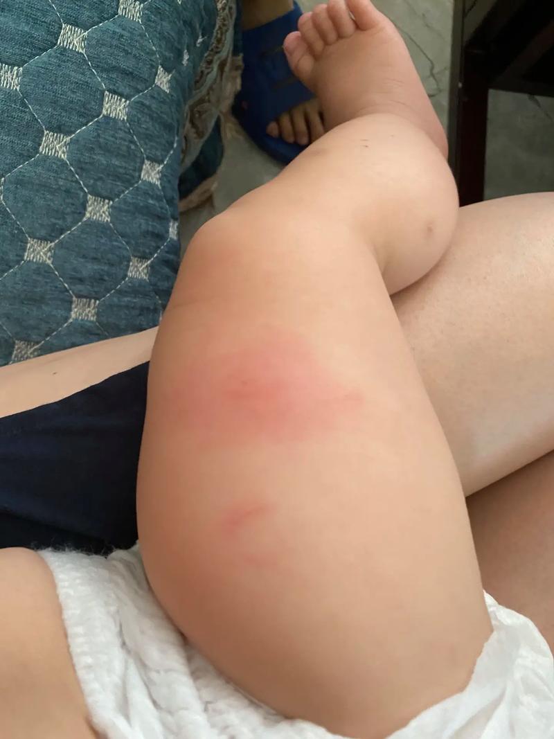 未满月新生儿被蚊子咬了怎么办？能用药吗？如何正确处理？-第3张图片-郑州医学网