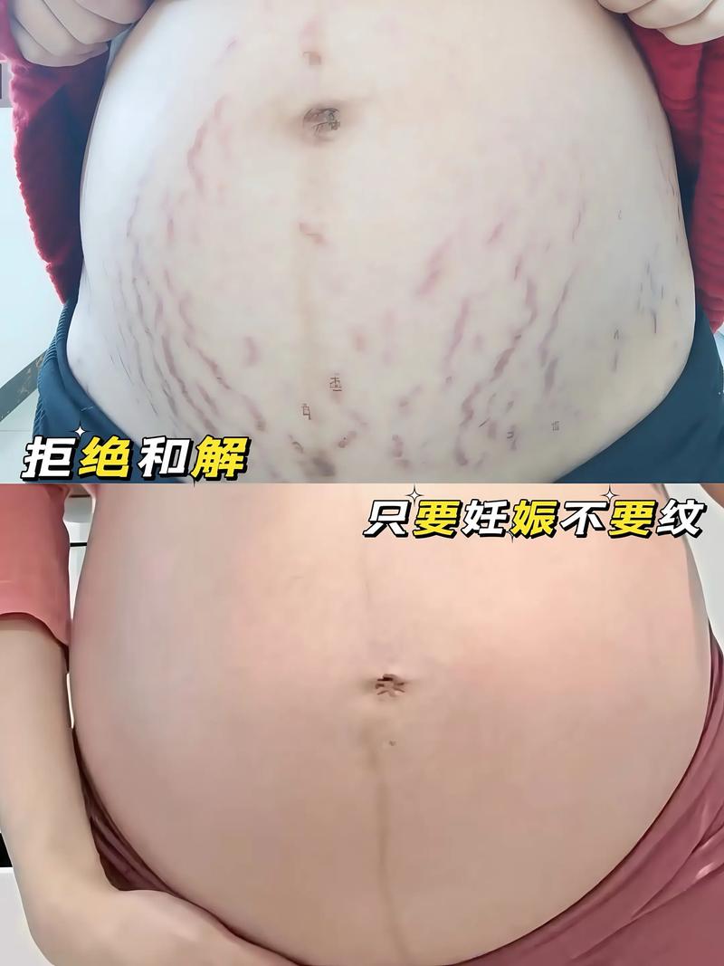 孕期长妊娠纹真的能抑制吗？有没有科学方法能减少或避免妊娠纹的出现？-第3张图片-郑州医学网