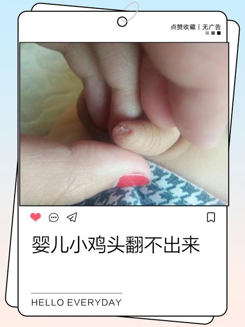 新生儿阴部外观正常吗？不同性别有哪些差异？需要特别护理吗？-第2张图片-郑州医学网