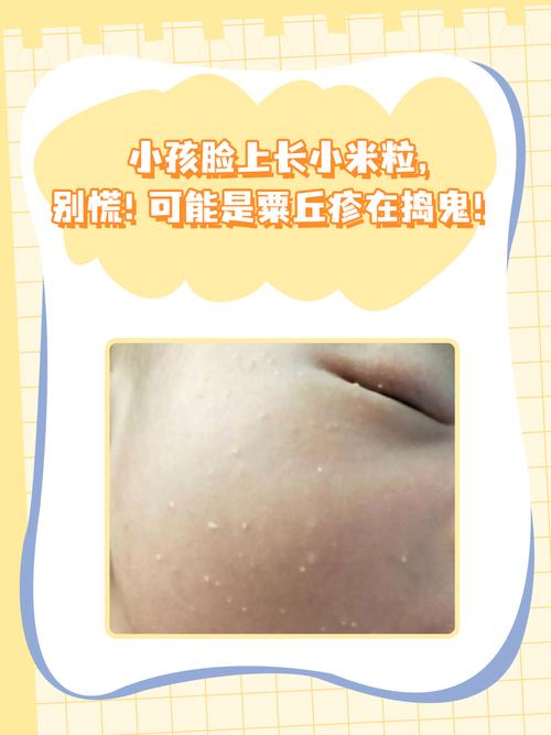 儿童脸上长小米粒疙瘩-第1张图片-郑州医学网