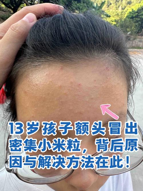 儿童脸上长小米粒疙瘩-第2张图片-郑州医学网
