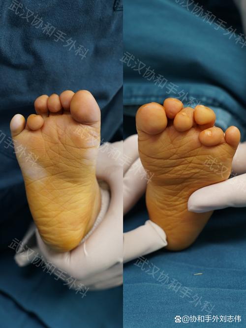 新生儿脚有劲就一定不是脑瘫吗？这些细节家长千万别忽视！-第2张图片-郑州医学网