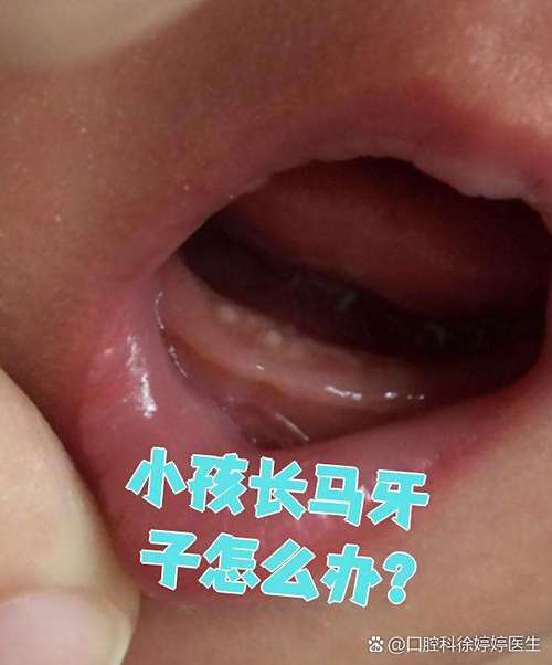 新生儿上牙龈马牙图片是什么样的？需要治疗吗？-第2张图片-郑州医学网