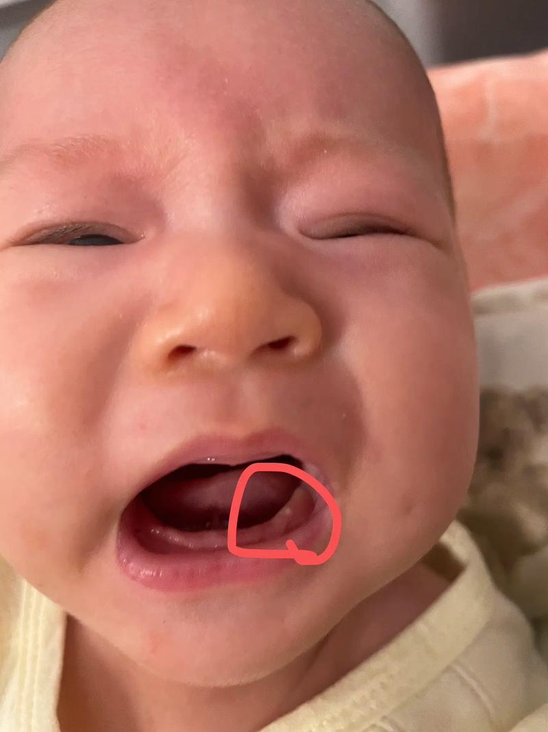 新生儿上牙龈马牙图片是什么样的？需要治疗吗？-第1张图片-郑州医学网