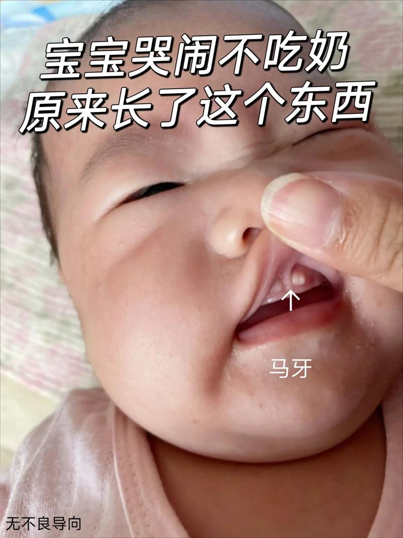 新生儿上牙龈马牙图片是什么样的？需要治疗吗？-第3张图片-郑州医学网
