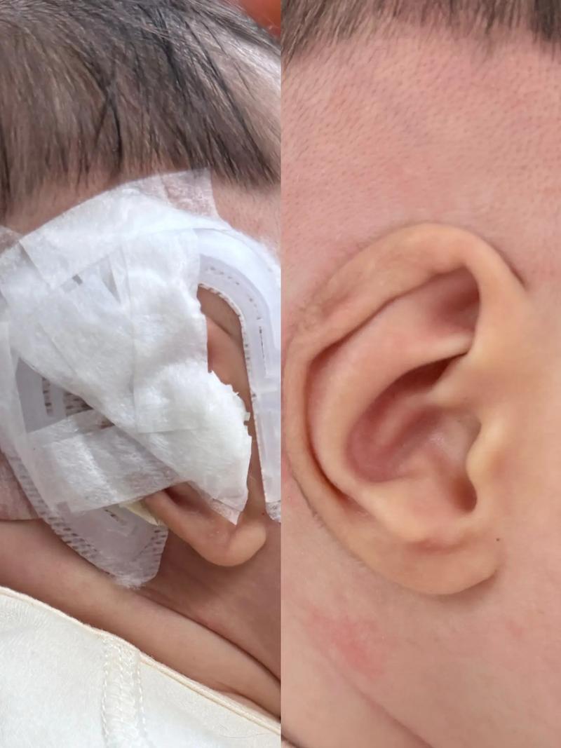 新生儿外耳道闭锁图片-第1张图片-郑州医学网 新生儿外耳道闭锁图片-第1张图片-郑州医学网