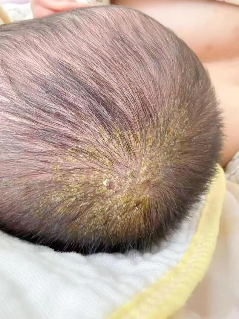 新生儿头上没有头垢是不是不正常？需要担心吗？-第1张图片-郑州医学网