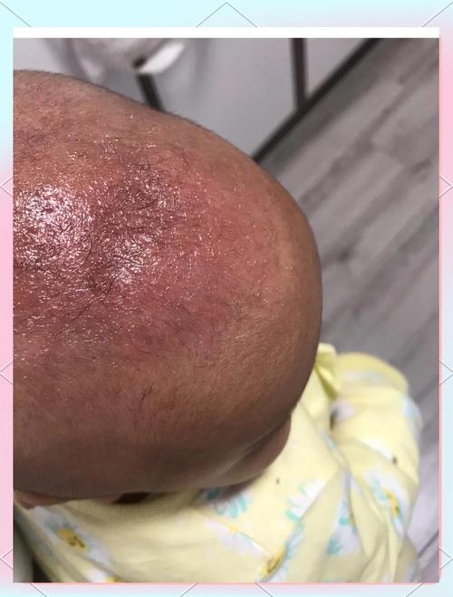 新生儿头上没有头垢是不是不正常？需要担心吗？-第3张图片-郑州医学网