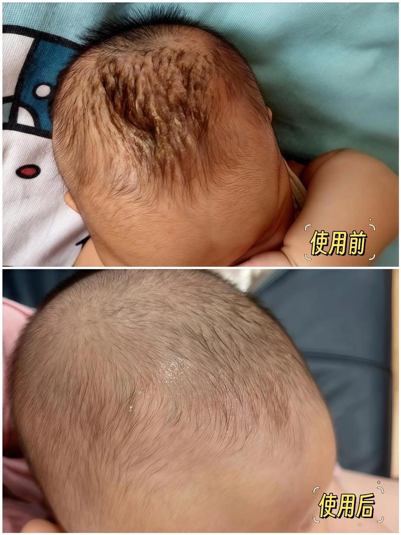 新生儿头上没有头垢是不是不正常？需要担心吗？-第2张图片-郑州医学网