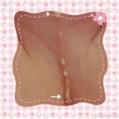 孕期尿道口出现小肉疙瘩是什么原因？需要担心吗？-第3张图片-郑州医学网