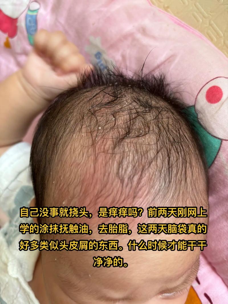 如何正确安全去除新生儿头上的顽固胎垢？-第1张图片-郑州医学网