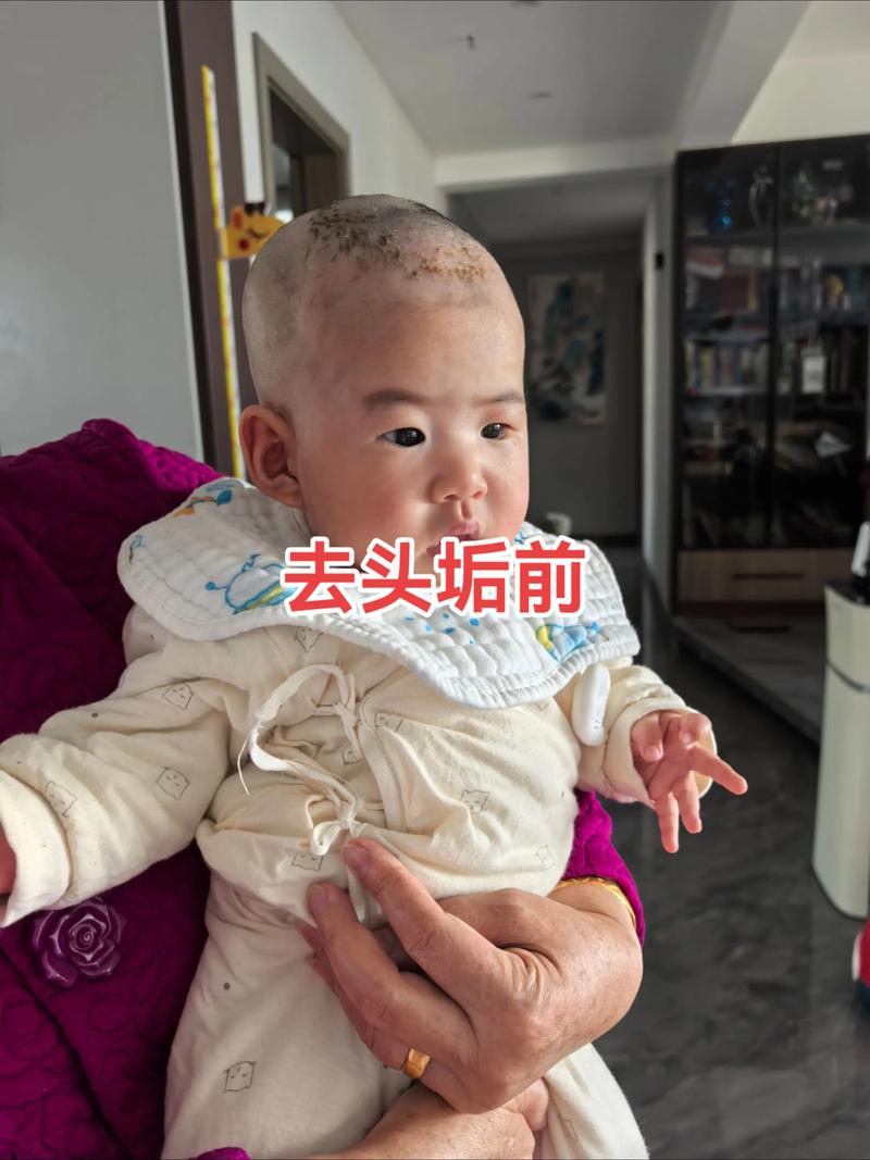 如何正确安全去除新生儿头上的顽固胎垢？-第2张图片-郑州医学网