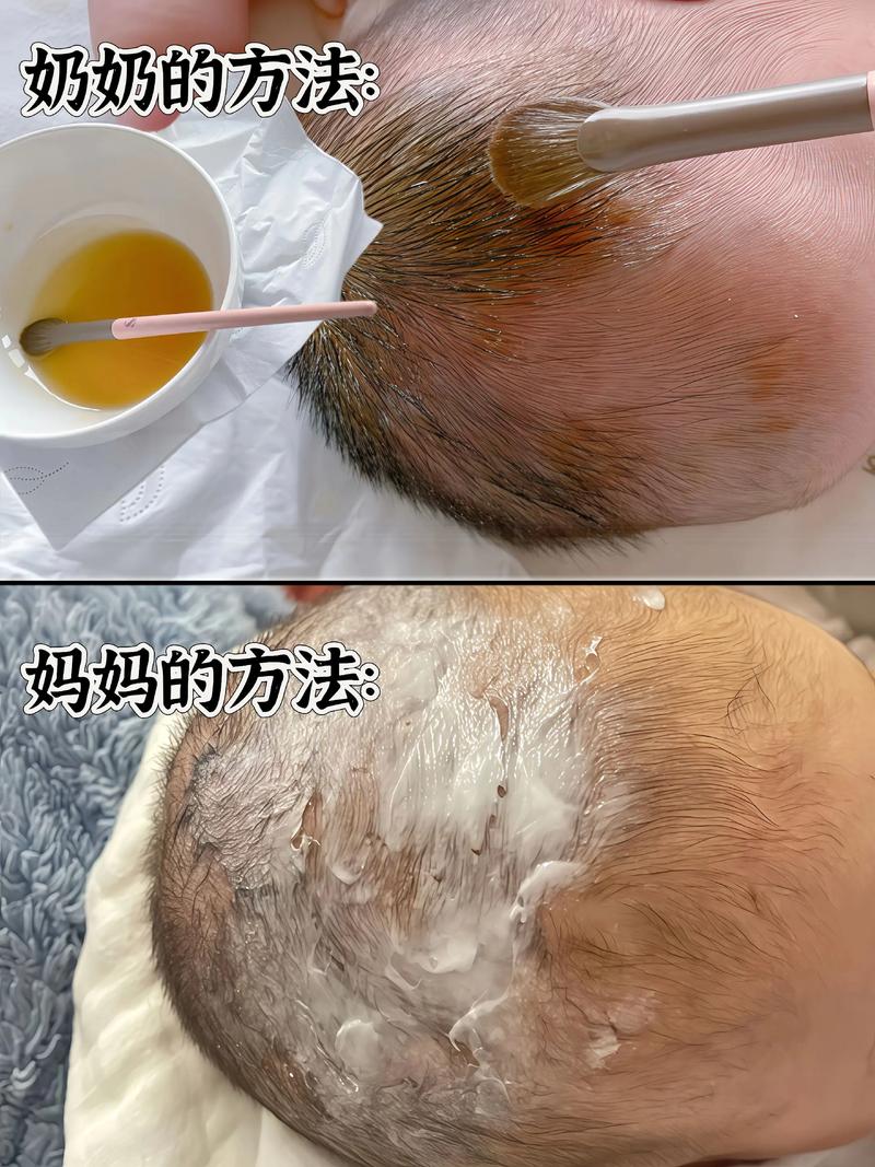 如何正确安全去除新生儿头上的顽固胎垢？-第3张图片-郑州医学网