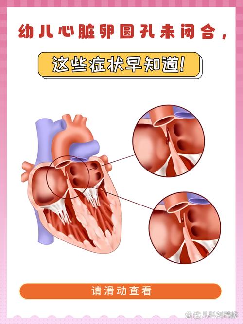 新生儿卵圆孔未闭究竟会带来哪些潜在危害?-第2张图片-郑州医学网 新生儿卵圆孔未闭究竟会带来哪些潜在危害?-第2张图片-郑州医学网