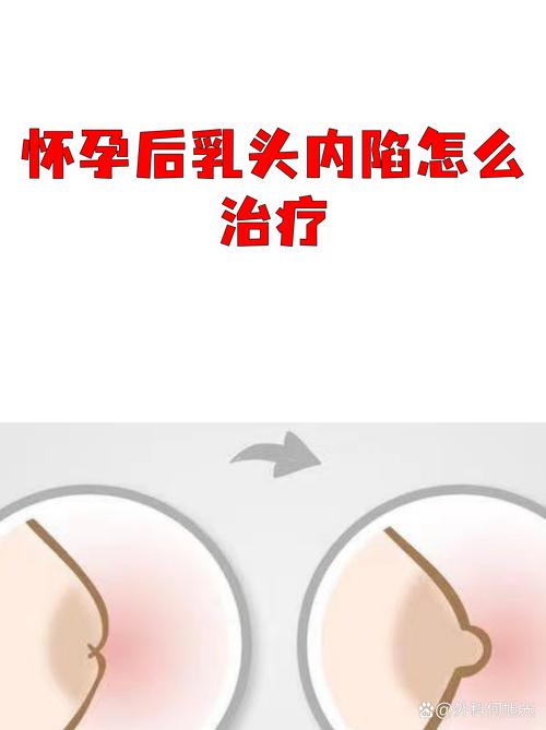 怀孕期间能否安全扣乳头？这样做会对胎儿或母乳喂养有影响吗？-第3张图片-郑州医学网