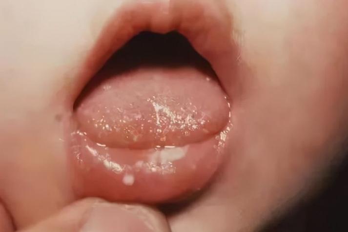 新生儿嘴上起白泡图片是正常的吗?需要担心什么问题?-第1张图片-郑州医学网 新生儿嘴上起白泡图片是正常的吗?需要担心什么问题?-第1张图片-郑州医学网