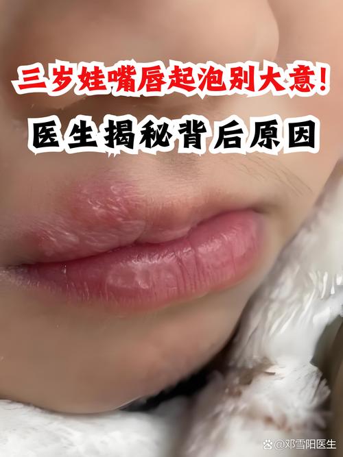 新生儿嘴上起白泡图片是正常的吗?需要担心什么问题?-第3张图片-郑州医学网 新生儿嘴上起白泡图片是正常的吗?需要担心什么问题?-第3张图片-郑州医学网