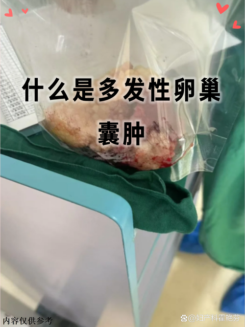 怀孕期间发现卵巢囊肿,会对胎儿和孕妇造成哪些影响?-第3张图片-郑州医学网 怀孕期间发现卵巢囊肿,会对胎儿和孕妇造成哪些影响?-第3张图片-郑州医学网