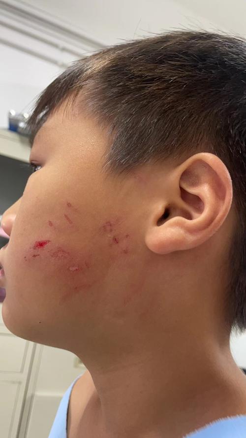 新生儿总抓破脸出血,到底该怎么办?-第1张图片-郑州医学网 新生儿总抓破脸出血,到底该怎么办?-第1张图片-郑州医学网