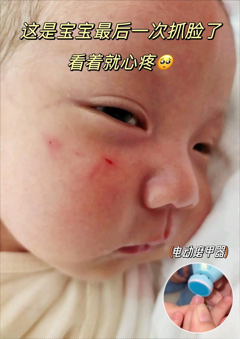 新生儿总抓破脸出血，到底该怎么办？-第2张图片-郑州医学网