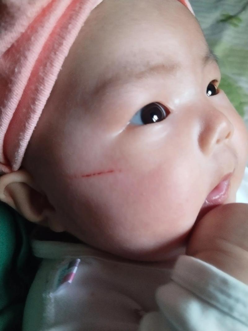 新生儿总抓破脸出血，到底该怎么办？-第3张图片-郑州医学网