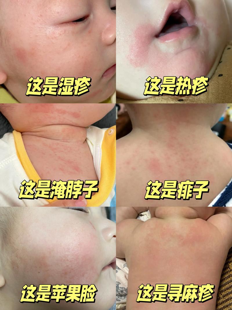 儿童皮肤病图片和症状,如何准确识别常见皮疹类型及应对措施?-第1张图片-郑州医学网 儿童皮肤病图片和症状,如何准确识别常见皮疹类型及应对措施?-第1张图片-郑州医学网