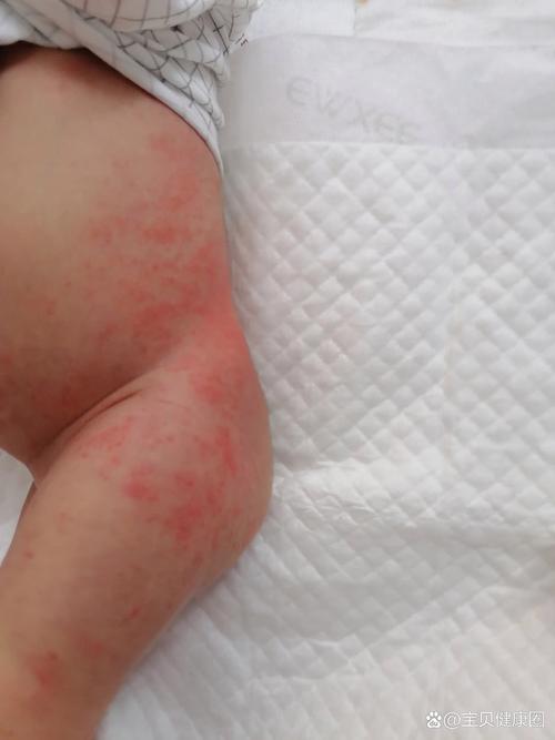 新生儿枕后红斑是什么?需要治疗吗?会自行消退吗?-第2张图片-郑州医学网 新生儿枕后红斑是什么?需要治疗吗?会自行消退吗?-第2张图片-郑州医学网