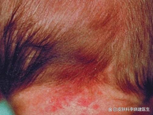 新生儿枕后红斑是什么?需要治疗吗?会自行消退吗?-第1张图片-郑州医学网 新生儿枕后红斑是什么?需要治疗吗?会自行消退吗?-第1张图片-郑州医学网