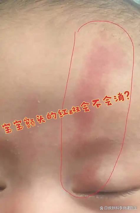 新生儿枕后红斑是什么?需要治疗吗?会自行消退吗?-第3张图片-郑州医学网 新生儿枕后红斑是什么?需要治疗吗?会自行消退吗?-第3张图片-郑州医学网