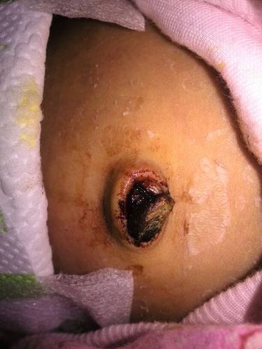 新生儿肚脐渗血一般持续多久?需要特殊处理吗?-第2张图片-郑州医学网 新生儿肚脐渗血一般持续多久?需要特殊处理吗?-第2张图片-郑州医学网